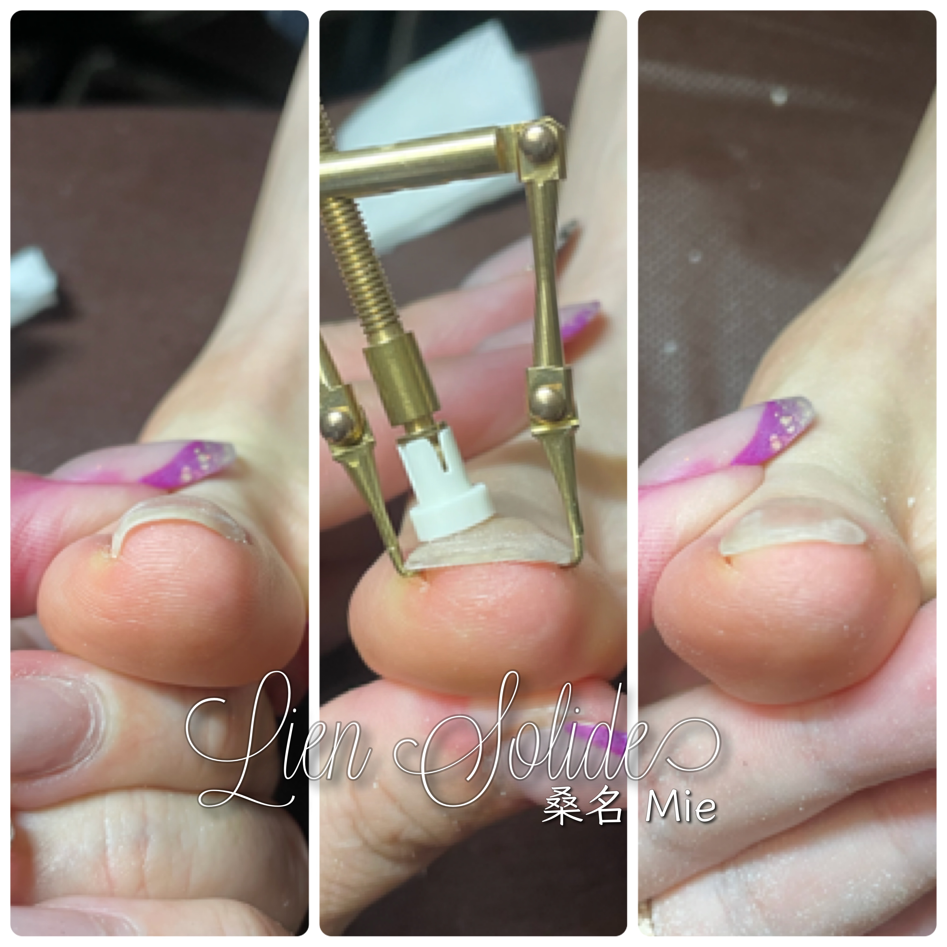 巻き爪矯正ロボ Nail Shop ネイルスマイル