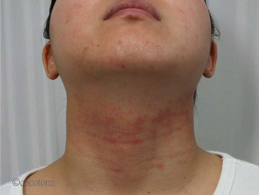 首もと痒くありませんか 肌トラブル解決 こことみ Cocotomi