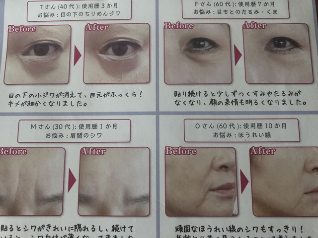 驚異の効果 目の下のお悩み ほうれい線 眉間のシワ Manok138