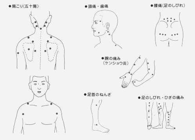 神洲 ひ鍼 ひしん 90針 円皮針 えんぴしん 治療器 肩こり 腰痛 筋肉痛 創健倶楽部 そうけんくらぶ